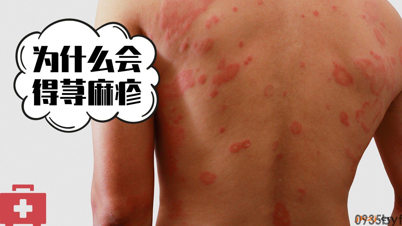 荨麻疹好了又复发是怎么办