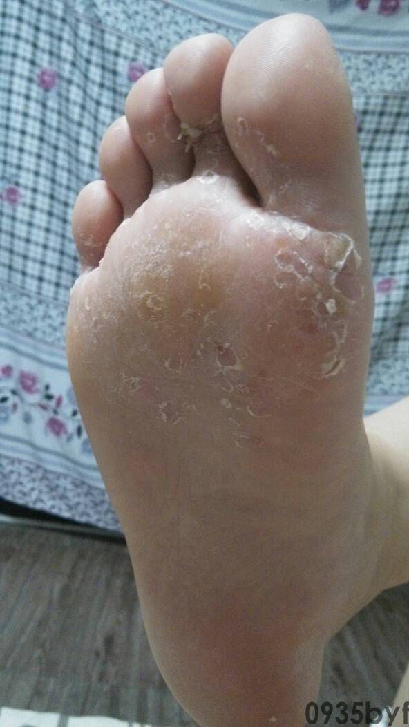 鳞屑角化型足癣脚底不规则脱皮图-有来医生