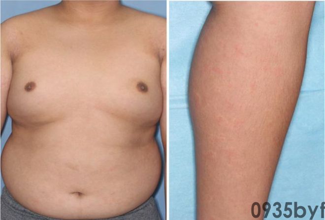 反复红斑10年会是什么病?看图诊断(图1) 反复红斑10年会是什么病?看图诊断(图1)