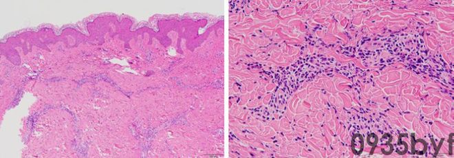 反复红斑10年会是什么病?看图诊断(图2) 反复红斑10年会是什么病?看图诊断(图2)