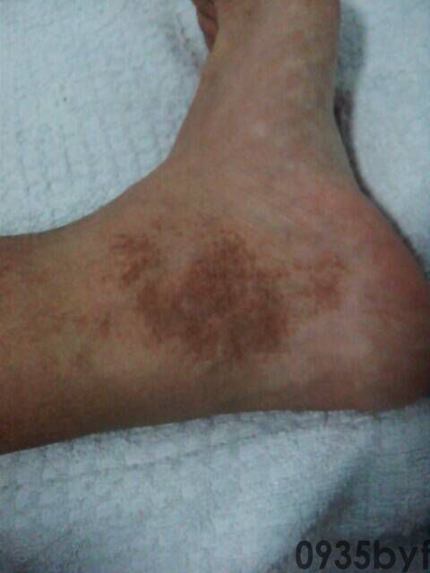 身上起红斑不痛不痒