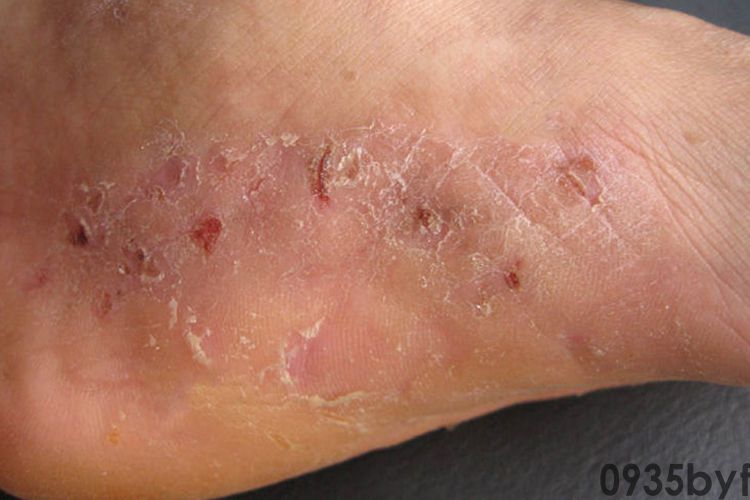 脚气图片其症状