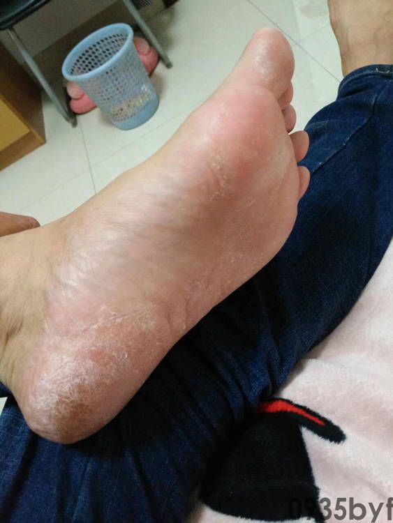 糜烂性脚气如何治疗(图1) 糜烂性脚气如何治疗
