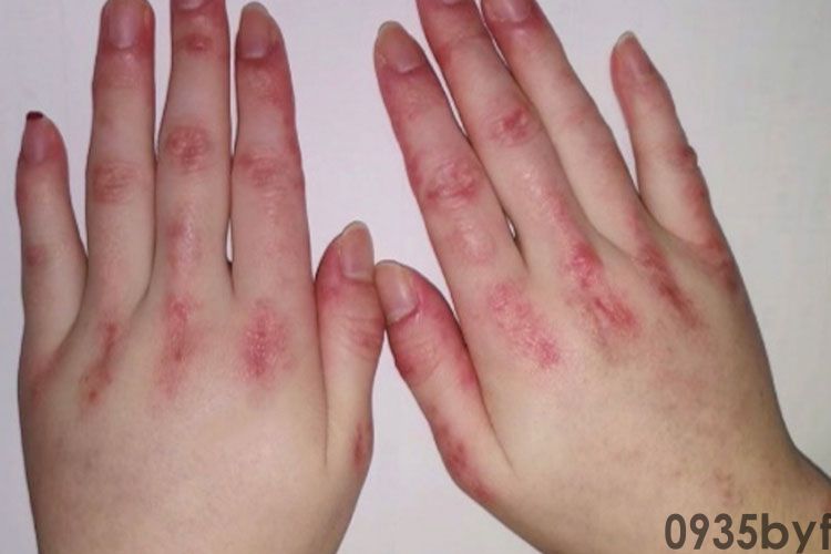 皮肤上有红斑有水泡是什么原因?(图1) 皮肤上有红斑有水泡是什么原因?