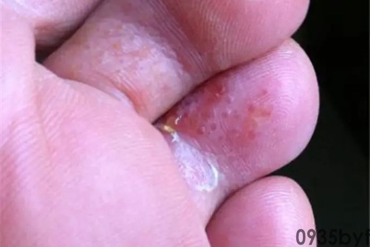 水疱型脚气是怎么引起的(图1) 水疱型脚气是怎么引起的