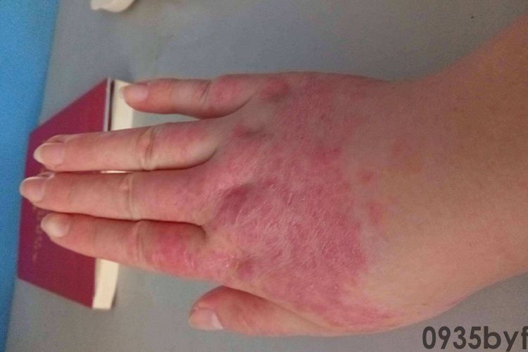 脚红斑块怎么治疗(图1) 脚红斑块怎么治疗