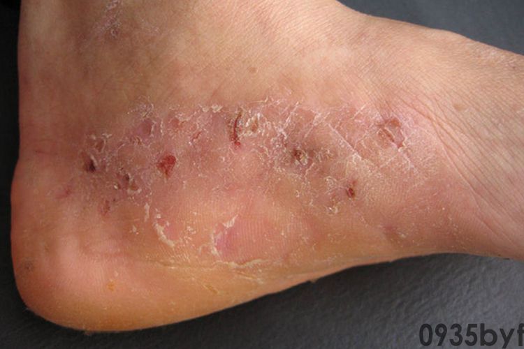 丘疹鳞屑型足癣有哪些表现?(图1) 丘疹鳞屑型足癣有哪些表现?