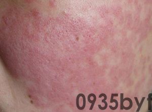 鲜红斑痣面颊部红色斑片图-有来医生