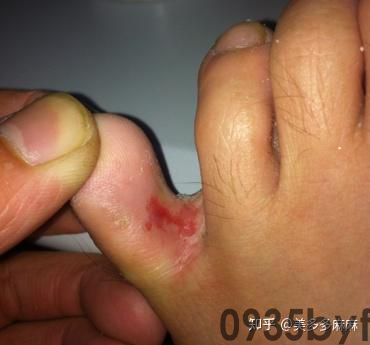 糜烂性脚癣症状有哪些(图1) 糜烂性脚癣症状有哪些