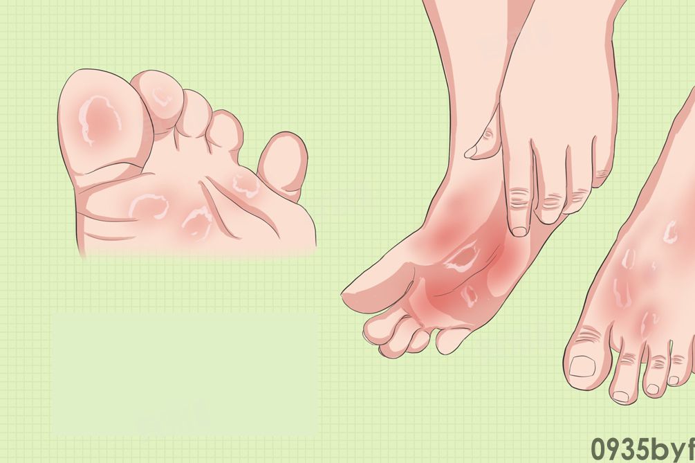 什么是脚气有哪些症状(图1) 什么是脚气有哪些症状(图1)