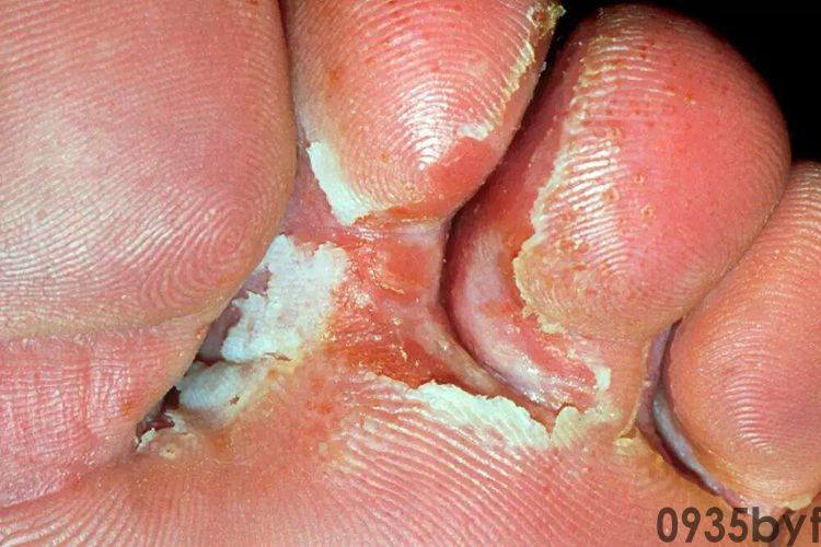 脚气能治好吗(图1) 脚气能治好吗