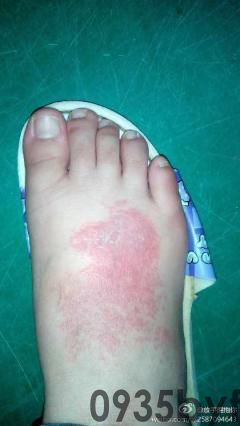 阴茎有红斑是怎么回事(图1) 阴茎有红斑是怎么回事