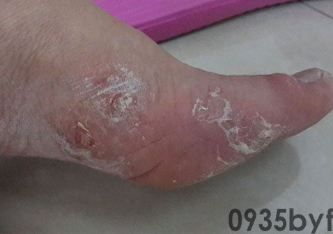 手感染脚气能自愈吗(图1) 手感染脚气能自愈吗