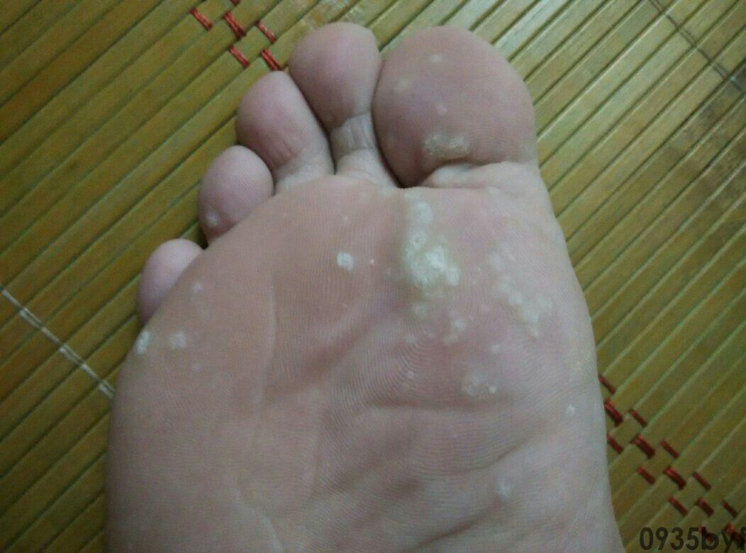 脚气图片ppt(图1) 脚气图片ppt