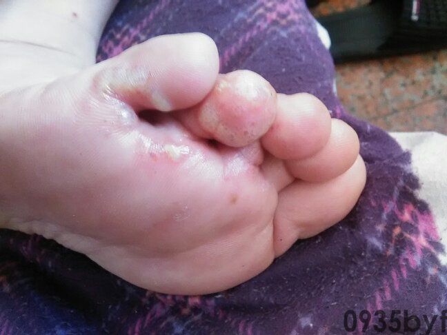 腐烂型脚气怎么治？