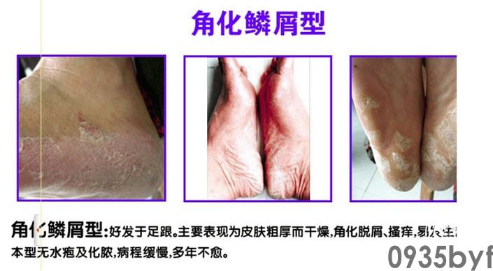 角化鳞屑型脚癣(图1) 角化鳞屑型脚癣