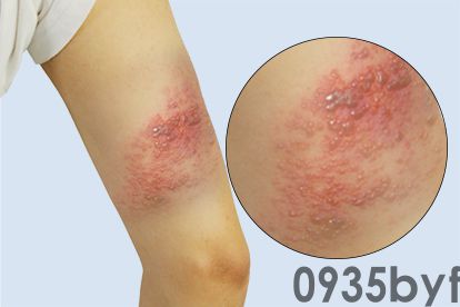 龟头红斑和包皮痒怎么回事