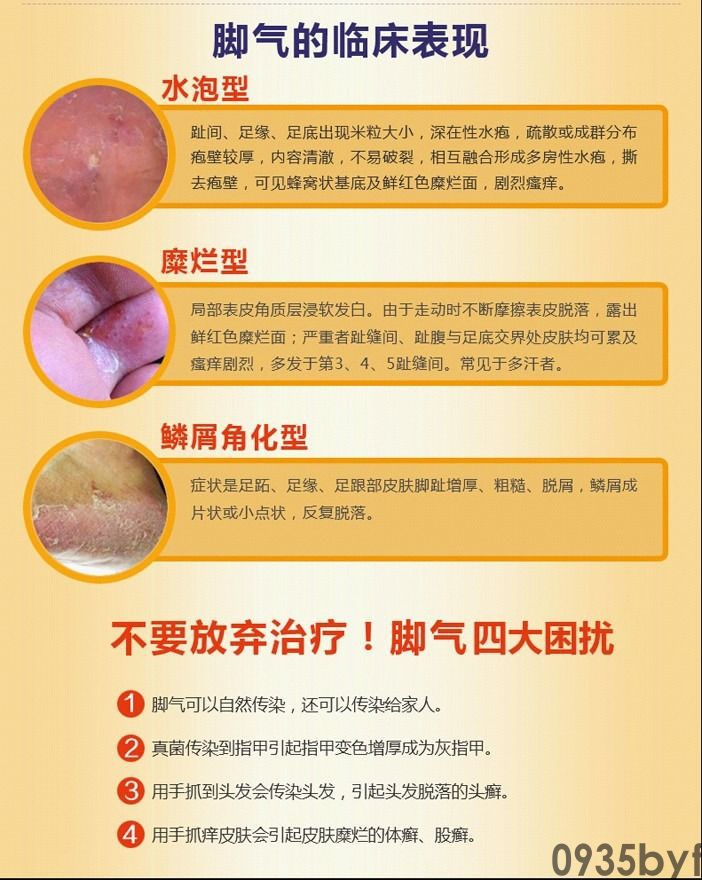 水泡型脚气产生的原因是什么?(图1) 水泡型脚气产生的原因是什么?
