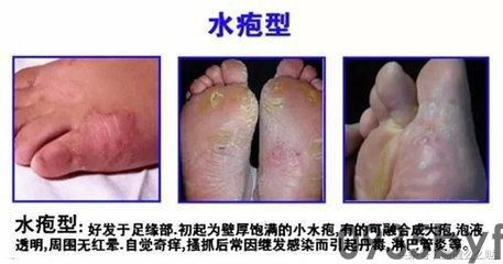 为什么会得水疱型脚气(图1) 为什么会得水疱型脚气