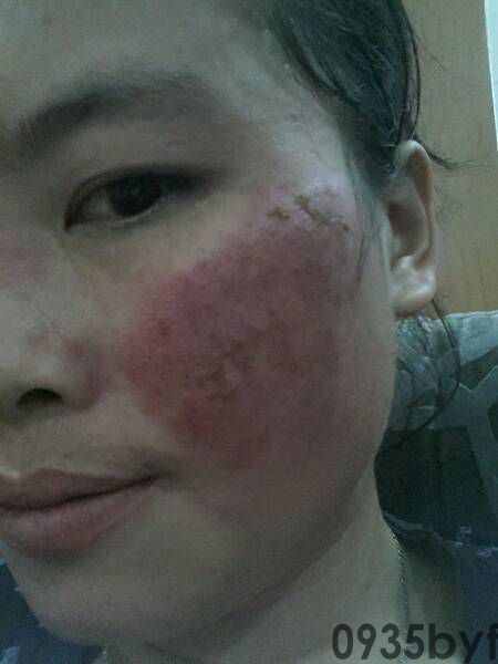 脚气种类及治疗方法