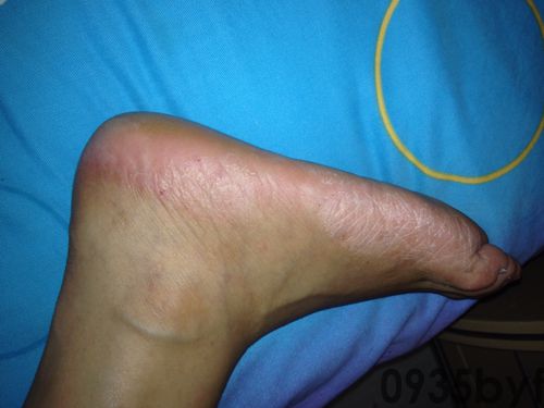 脚气鳞屑角化型的治疗与预防方法