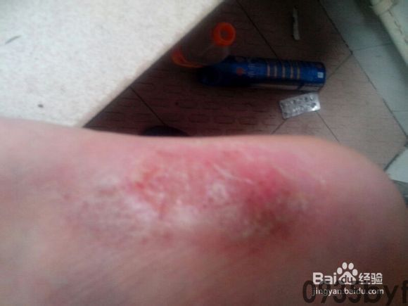 水泡型脚气擦什么药(图1) 水泡型脚气擦什么药