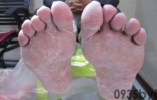 脚气病不能根冶是什么原因(图1) 脚气病不能根冶是什么原因
