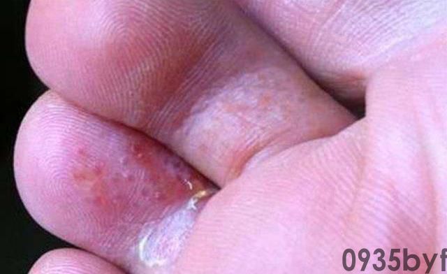 脚气水泡怎么治疗