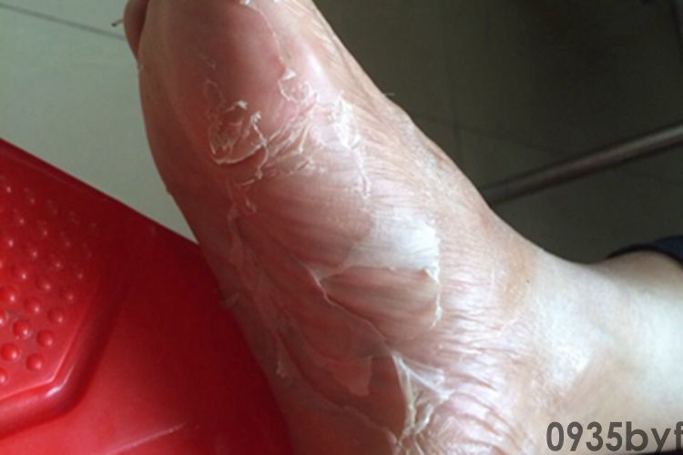 足癣脚部脱皮图片(图2)