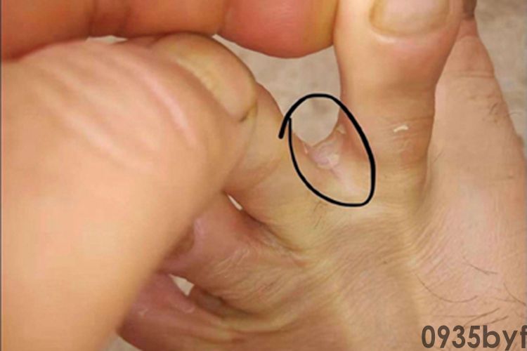 糜烂型足癣脚趾缝症状图片(图1)