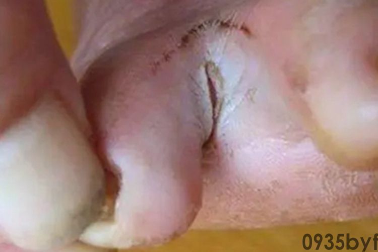 糜烂型足癣脚趾缝症状图片(图2)