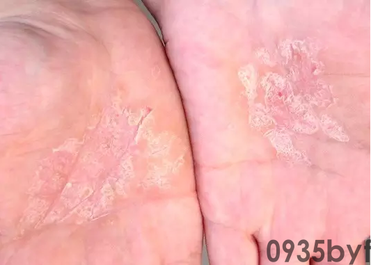 脚气会传染给别人吗(图1) 脚气会传染给别人吗