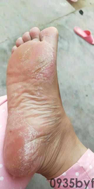 脚气痒怎么办-有来医生