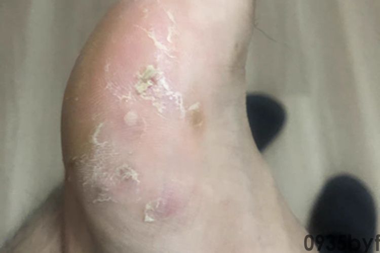 水疱型足癣脚部脱皮图片(图1)