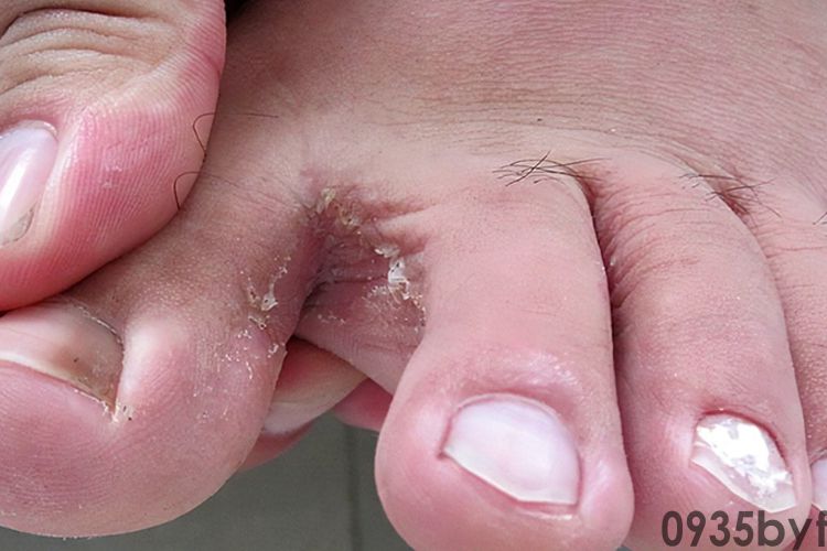 糜烂型脚气涂什么药膏好