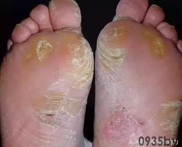 脚气初期症状有哪些