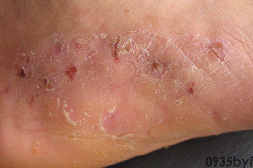 治疗糜烂型脚气需要多少钱？