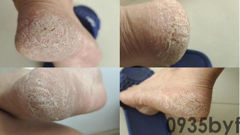 脚气的症状有哪些?都是什么样?(图3) 脚气的症状有哪些?都是什么样?(图3)