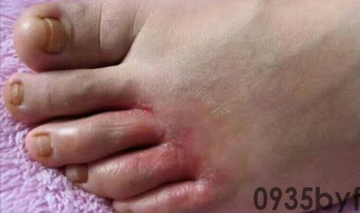 脚气的症状有哪些?都是什么样?(图2) 脚气的症状有哪些?都是什么样?(图2)