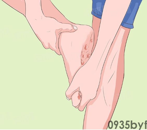 脚气是怎么样的(图1) 脚气是怎么样的(图1)