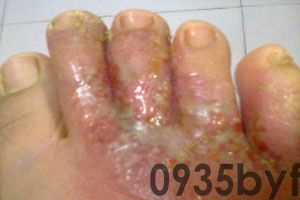 糜烂性脚气解决脚气方法？