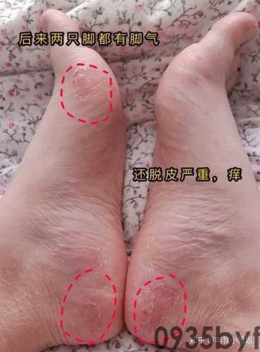 脚气的症状？