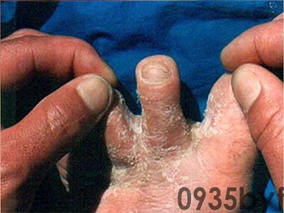 脚气症状的图片主要有哪些(图1) 脚气症状的图片主要有哪些(图1)