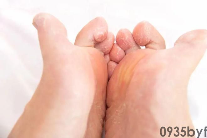 脚气拖延不治后果可能超出你想象(图1) 脚气拖延不治后果可能超出你想象(图1)