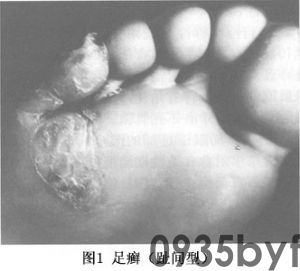 脚癣_脚癣的病因病机、临床表现、诊断、中医辨证治疗_医学百科(图1) 脚癣_脚癣的病因病机、临床表现、诊断、中医辨证治疗_医学百科(图1)