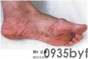 脚癣_脚癣的病因病机、临床表现、诊断、中医辨证治疗_医学百科(图2) 脚癣_脚癣的病因病机、临床表现、诊断、中医辨证治疗_医学百科(图2)