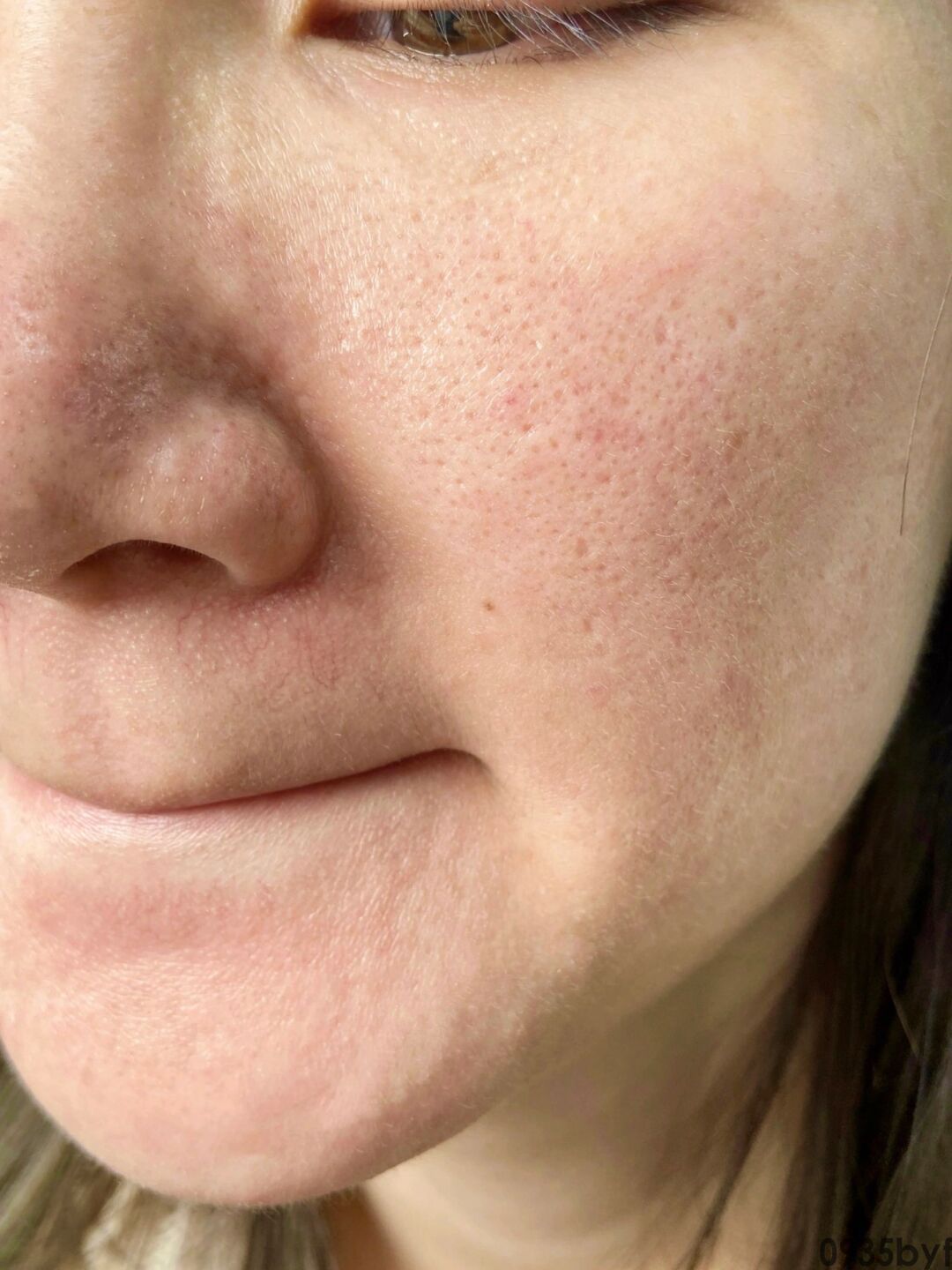 红斑狼疮是什么病怎么引起的(图1) 红斑狼疮是什么病怎么引起的