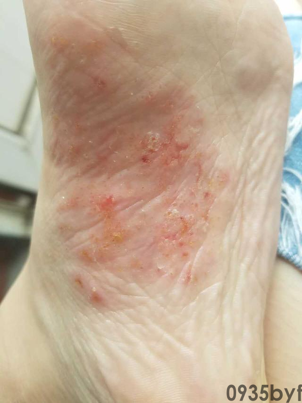 常见几类脚气的介绍