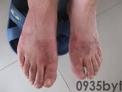 糜烂型脚气的症状论文资料