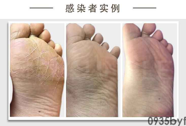 脚气水泡型用什么药膏最好(图1) 脚气水泡型用什么药膏最好